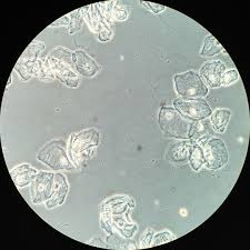 Pin On Nephro Pics