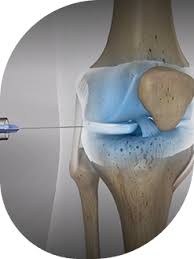Image result for Knee Joint Injection