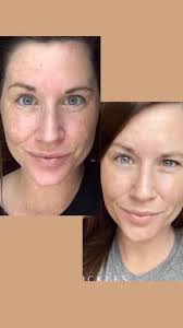 ✨ Some before and afters! Our skincare is proven to give results in just 14  days. Since its naturally based, you won't get the side effects of harsh  chemicals whichtake only 26
