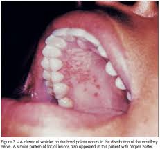 Image result for Mouth ulcers symptoms roof of the mouth