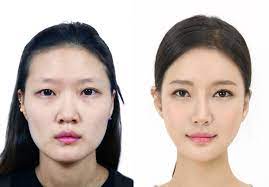 The fifth of 5 operations you don&apost want to get—and what to do instead. Cheongdam U Plastic Surgery Dermatology Korea Seoul South Korea