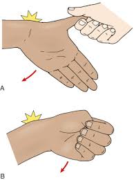 De quervain's tenosynovitis is an inflammation of the tendon sheath around the abductor pollicis longus (apl) and extensor pollicis brevis (epb) tendons. De Quervain Tenosynovitis Musculoskeletal Key