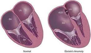 Ebstein's anomaly is a congenital heart defect in which the opening of the tricuspid valve is displaced towards. Ebstein S Anomaly Learntheheart Com