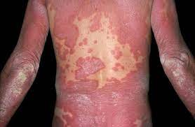 Psoriasis Especially Severe Disease Associated With Increased Risk For All Cause Mortality Dermatology Advisor