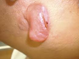Image result for Dermatofibrosarcoma Protuberans