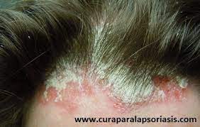 Tratamiento Para La Psoriasis En El Cuero Cabelludo Psoriasis Del Cuero Cabelludo Psoriasis Cuero Cabelludo