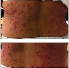 Endemic typhus — murine typhus, an acute infectious disease with fever, headache, and rash, all quite similar to, but milder than, epidemic typhus, caused by a related microorganism, rickettsia typhi. Scielo Brasil Murine Typhus In Mexico City Report Of An Imported Case Murine Typhus In Mexico City Report Of An Imported Case
