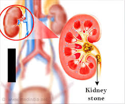 New Urine Test Holds Promise For Kidney Stone Sufferers