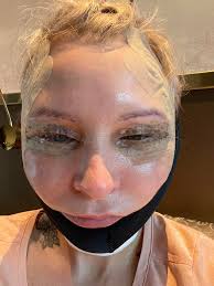 Would love some advice. I have had some under eye injections (redensity 1)  and have some swelling under my eye. It looks like they could bruise a bit.  I start a new