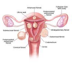 It did not turn out that i had ovarian cancer. Uterine Fibroids Informedhealth Org