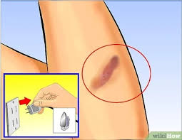 Jedenfalls habe ich seither hinter dem brustbein einen leichten schmerz, der sich beim schlucken verstärkt. Verbrennungen Mit Aloe Vera Behandeln 9 Schritte Mit Bildern Wikihow