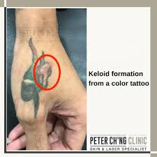 They occur where the skin has healed after an injury. 5 Complications Of Tattoo Think Wisely Before You Ink Peter Ch Ng Skin Specialist Kl Malaysia