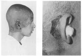 But unlike hair loss during chemotherapy, it only causes hair loss in the area being treated. View Of Mastoid Radiation Ulcer 4 Months After Radiotherapy Download Scientific Diagram