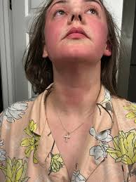 Do people randomly get rashes and flushed hot cheeks? Feels like my cheeks  are