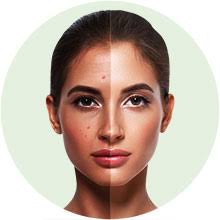 Acne is a common disease that concerns not only qualified doctors of hair transplantation and skin health clinic rubenhair latvia will treat and remove the scars. 4vdrnvhy3xuwam