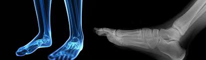 Image result for Foot XRay