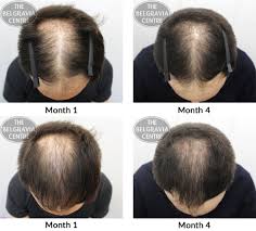 When your hair is healthy and not experiencing thinning, 90% of it will be in this phase at any one time where it will remain. Hair Growth Success 3 Months In And Making Visible Progress