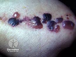 Image result for Pemphigoid