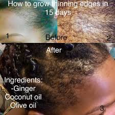 How To Grow Your Thinning Edges Back Apply The Following Mix Everyday In The Desired Area As Follow Mas Thinning Edges Black Hair Growth Ways To Grow Hair