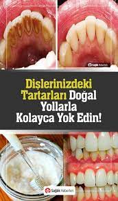 Farklı farklı tarifler ile doğal olarak diş taşı nasıl temizlenir? Hicbir Dis Hekimi Bunun Bilinmesini Istemez Dislerdeki Plaklari Kolayca Ortadan Kaldirin Dogal Dis Beyazlatma Dis Saglik