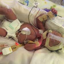 Rh Disease Leads To 28 Transfusions For Baby Mack