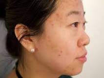 Image result for acne treatment what to avoid
