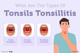 Image result for Tonsillitis
