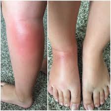 Bug Bites That Look Like Mosquito Bites But Hurt What A Nightmare Read How One Family Dealt With Their Little Girl S Reaction To Mosq Remedies For Mosquito Bites Allergic To Mosquito Bites Bug Bites Remedies