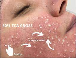 We recommend the 20% or 30% for this method. Tca Cross Chemical Reconstruction Of Dr Anil Anti Ageing Facebook