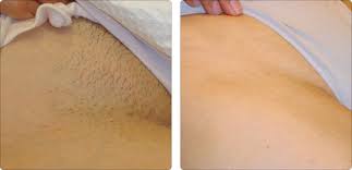I just got laser hair removal on my stomach but i got burned. Laser Hair Removal Hayes Valley Medical Esthetics