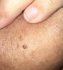 Two new studies find an association between breast cancer and moles. I Found A Weird Looking Mole On My Breast Could It Be Skin Cancer Ask A Doctor Free Best Answers Reviews Recommendations