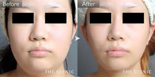 頰 顎の脂肪吸引 痩身の症例写真 the clinic ザクリニック 脂肪吸引 脂肪 顎