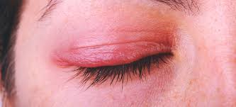 blepharitis 7 natural treatments to