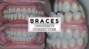For some patients this may be the best course of treatment. Underbite Is Correcting Braces Progress After A Year Adult Braces Correcting An Underbite Youtube