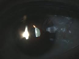 Két típusa a cataracta corticalis és a cataracta nuclearis. Cataracta Corticalis Praxis Zeitz Franko Zeitz