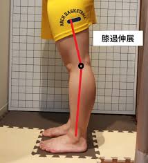 膝 の 過 伸展