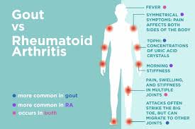 Gout Vs Rheumatoid Arthritis Whats The Difference