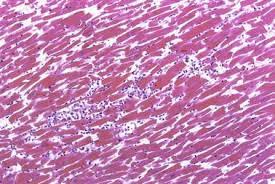 Myokarditis Springerlink