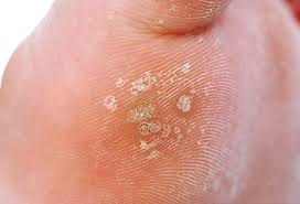 We did not find results for: Plantar Wart Removal Treatment Causes Images Remedies Symptoms