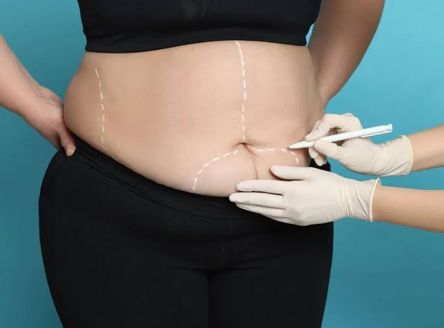 Can Stomach Grow After Bariatric Surgery - Perfect Doctors Clinic