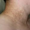 Frauen mit einem pcos haben wesentlich häufiger akne als der durchschnitt der bevölkerung in deutschland. 1