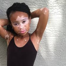 When Star Was Six Years Old She Was Diagnosed With The Skin Condition Vitiligo Vitiligo Model Body Skin Condition And Treatment Vitiligo