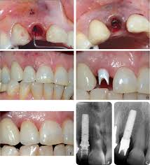 + soldesam prescrivibilit & agrave; Immediate And Early Function Of Implants Placed In Extraction Sockets Of Maxillary Infected Teeth A Pilot Study Sciencedirect