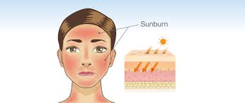 It's really important that you follow these guidelines to minimize sun damage: 5 Ways To Treat Sunburn News Digest Healthy Options