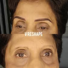 V reshape and 10 years younger 🤩