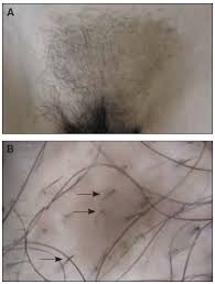 Wet the area with a warm washcloth, or soak first in the bathtub for at least three minutes. Racgp Patchy Hair Loss On The Pubis A Case Study