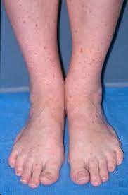 They may be raised or flat, and different sizes. Henoch Schonlein Purpura Johns Hopkins Vasculitis Center