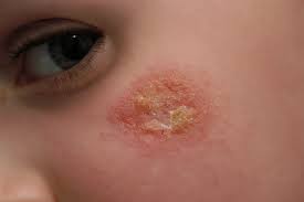 Image result for yellow scabs on the face in children