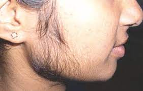 Technically, you still have to remove the excess facial hair, as growth is halted. When Females Develop Facial Hair The Daily Star
