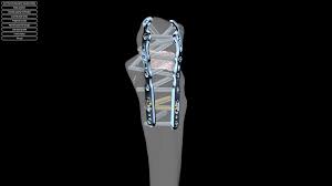 The projection that forms the lower border of the trochlear notch, the coronoid process, enters the coronoid fossa of the humerus when the elbow… Product Medartis Ag